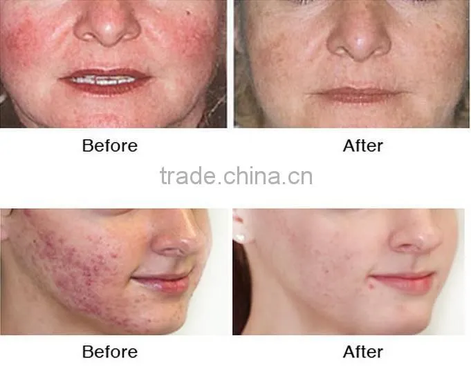 AYJ-X11B-C multifuction facial therapy spa equipment