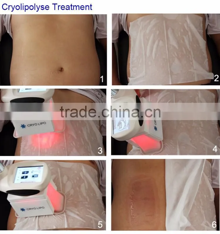 Freezing Fat Away Weight Loss Ice Sculpt Cryolipolyse