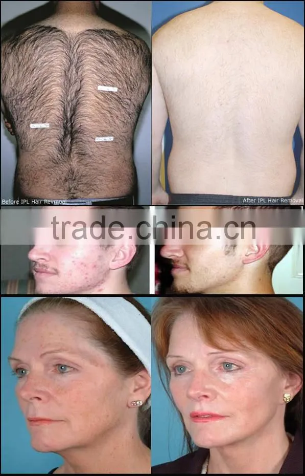 Intense pulsed light acne removal blue light therapy for acne