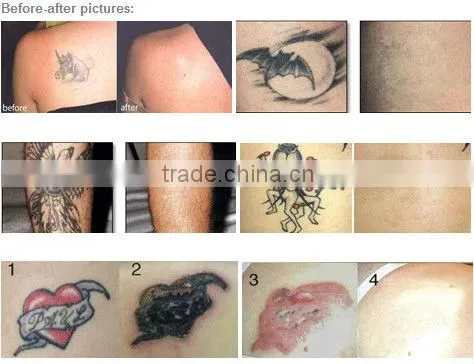 Cheapest 2014 !!!! popular q switch nd yag laser cream tattoo removal
