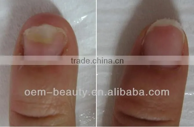 Home nd yag hair removal 1064 laser depilation onychomycosis device