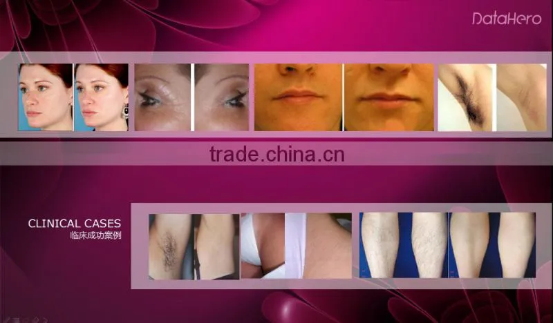 2016 Newest IPL Hair Removal Machine Prices / factory price ipl hand elight