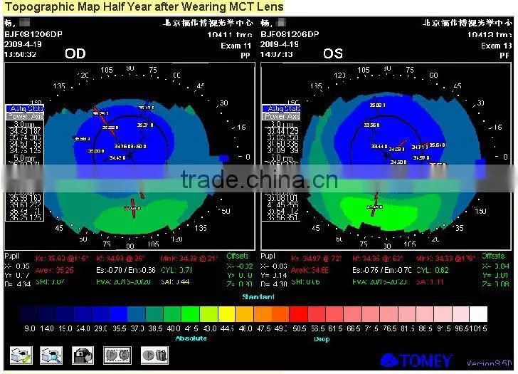 After Laser Surgery/MCT-L/High-end MCT Technology improve of OK Lenses