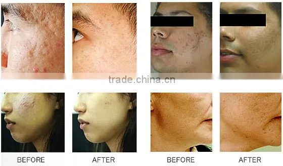 AYJ-SS03B hot product hydra oxygen jet peel water jet machine
