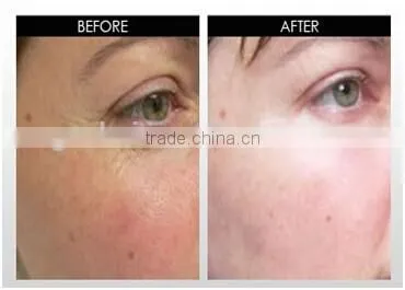 180 needles micro needle roller eye treatment derma roller