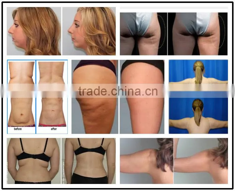 bodybuilding machine remove fat cells naturally