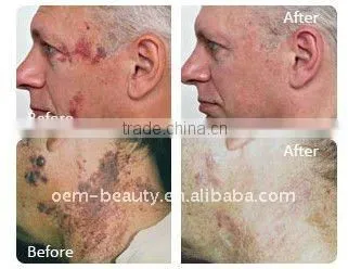 Stationary Hair Removal Machine IPL Laser Equipment-C009