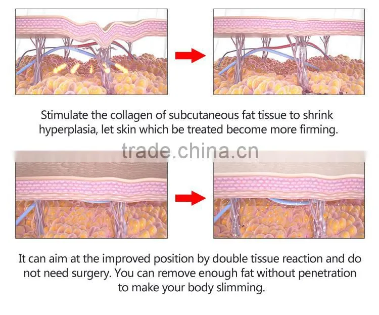 Fashionable product ultrasound hifushape for slimming skin tighten machine