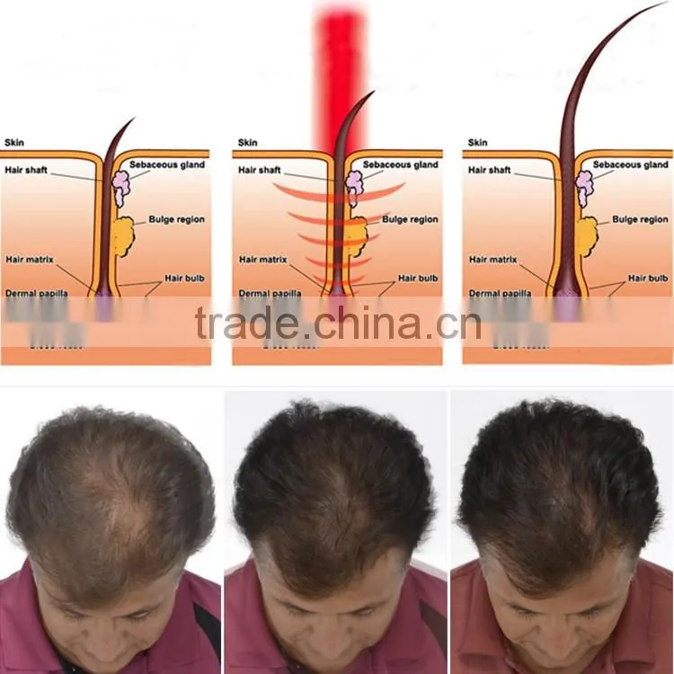 Manufactory PDT Led Hair Regrowth Laser Treatment/ laser Hair Regrowth Machine