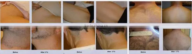 Lightsheer Laser Hair Removal Machine for Sale