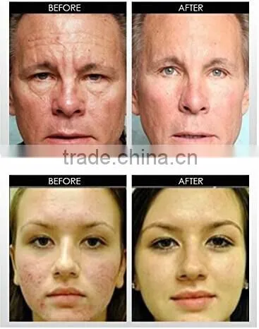 scar removal derma roller with changeable heads 1200 needles beauty roller
