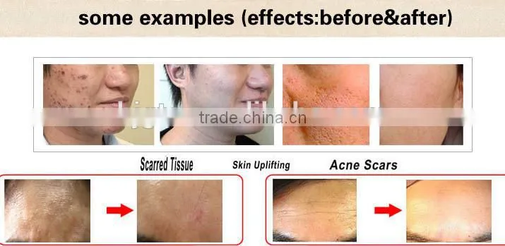 wholesale manufacture GTO microneedle 540 derma roller