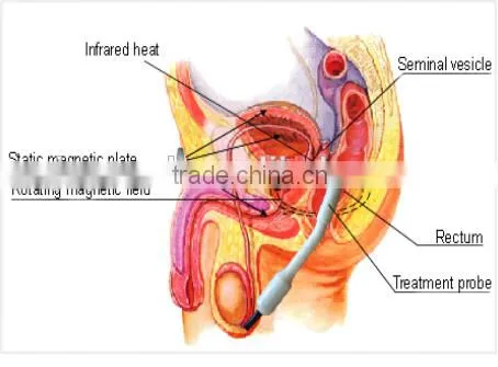 portable infrared light prostate therapy device BPH machine