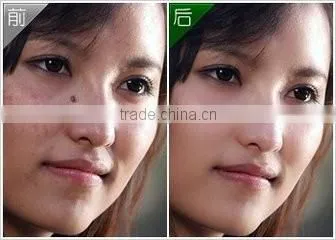 Micro Portable Handhold freckles removal pen