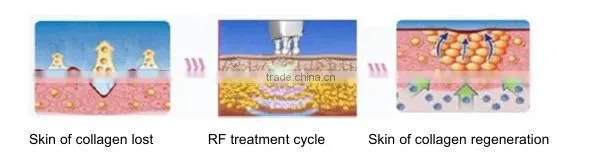 Beauty supply skin tightening thermagic rf machine