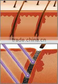Beauty hair removal ipl machine HM-IPL-B2+