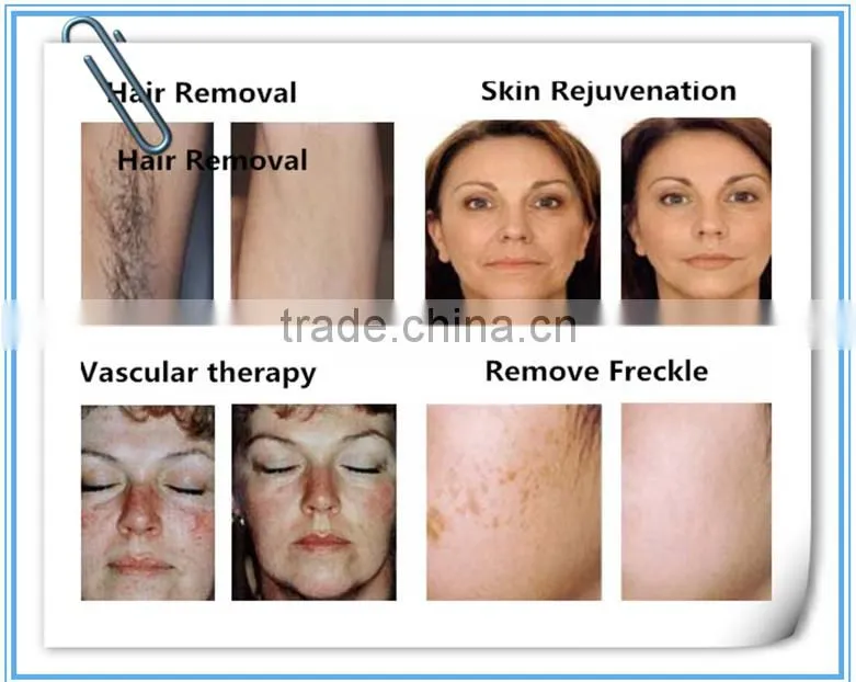 Multifunctional IPL 808nm diode laser hair removal beauty machine