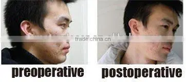 Removal Scar CO2 fractional laser beauty equipment