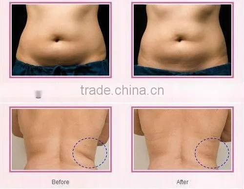 tripolar rf beauty machine multipolar rf machine