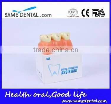 4 times the cavities progress model Dental Eduction Assitant No. DEA-16
