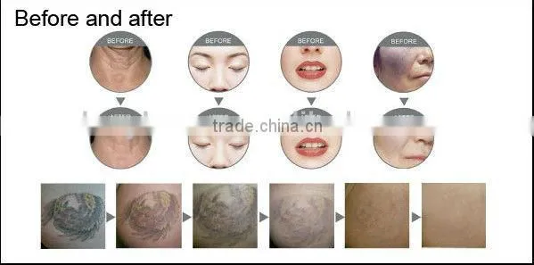 1064nm nd yag laser for nail fungus lasylaser V18