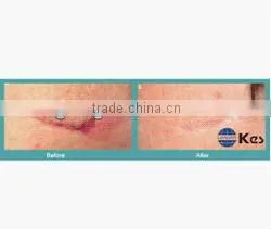 skin renewing co2 laser scar treatment co2 fractional laser co2 surgical laser instrument