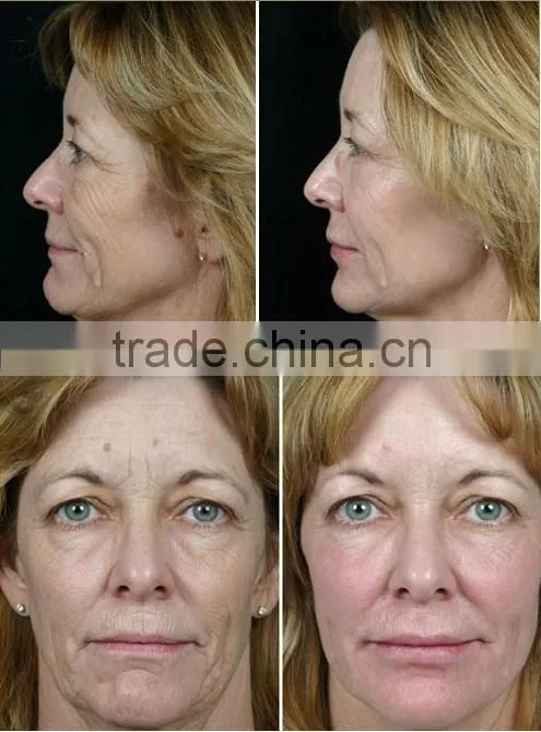 Micro machine Skin Tightening Face Lifting gun facial injection system No Needle Mesotherapy for home use