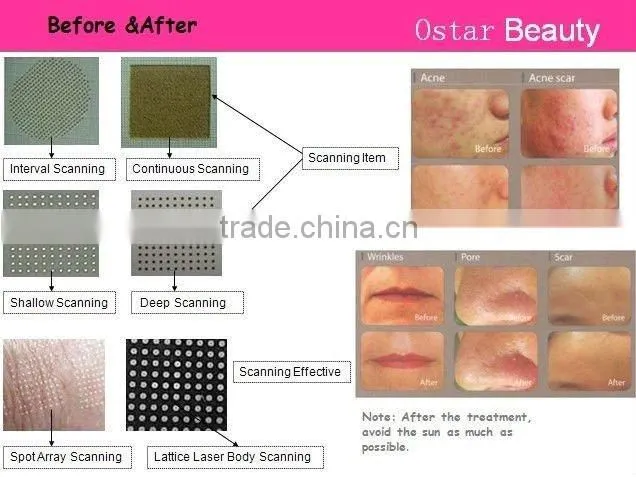 CO2 fractional laser scar removal machine for skin care OB-FC 01