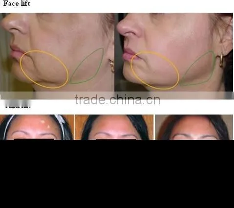 2012 RF facial lifting and firming machine