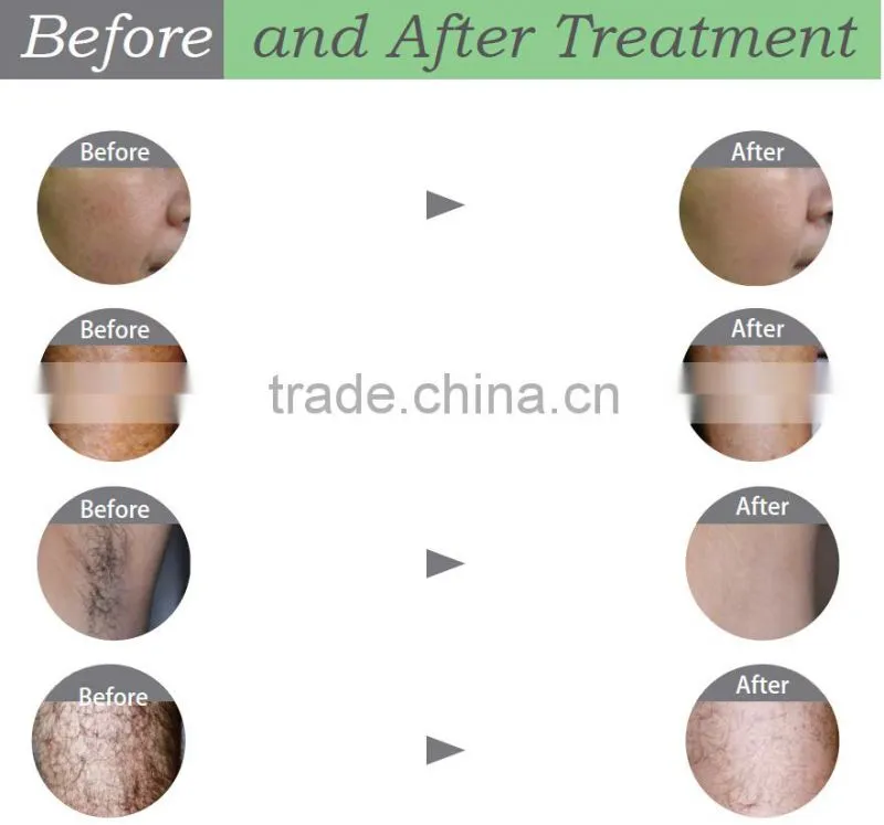 2016 Hot Sell !! Spa SHR IPL Laser Hair Removal Machine For Sale SHR IPL Elight RF Hair Removal