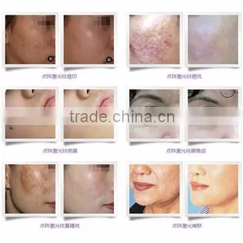 portable Fractional Co2 Laser Surgical Products