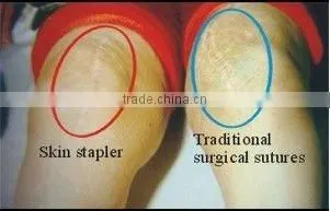 Surgical Sterile Disposable Skin Stapler