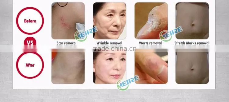 Factory price CE approved fractional co2 laser scar removal glass tube fractional co2 laser