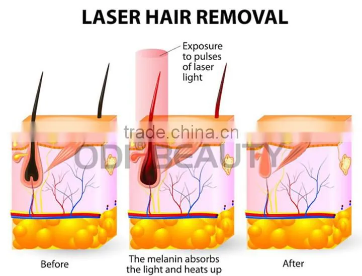 Fast result painless unhairing 808nm diode laser treatment