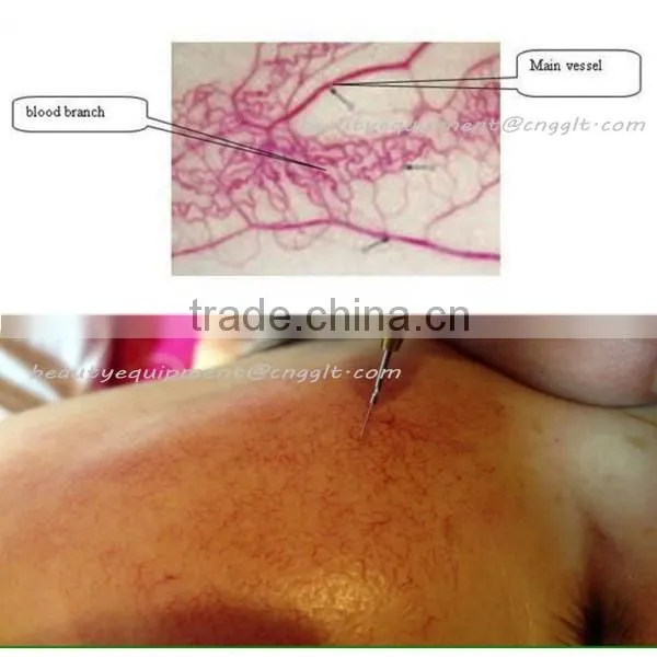 Professional RBS spider vein removal machine with best treatment effect