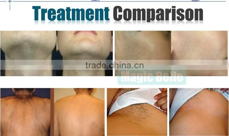 Portable OPT SHR IPL hair removal machine skin rejuvenation acne remove beauty equipment