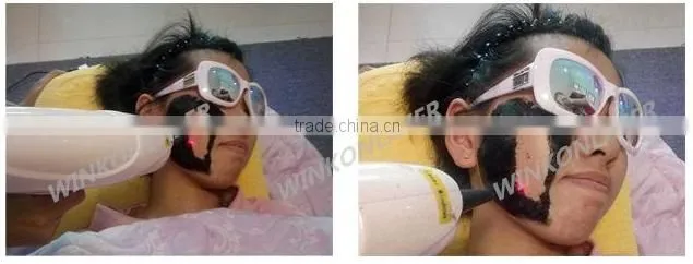 portable ipl / xenon lamps for ipl / home ipl