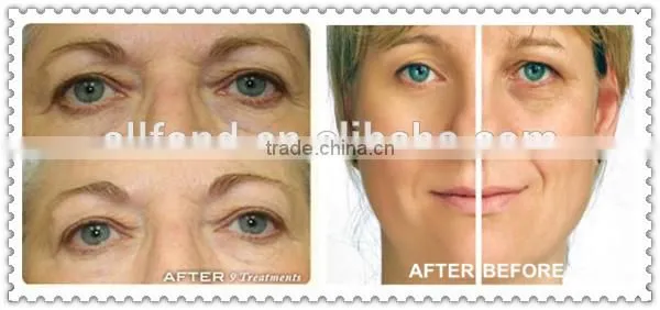 Hot selling bio skin lifting machine