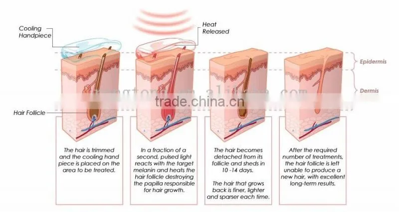 808nm diode hair removal laser personalization machine