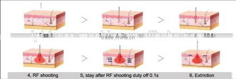 Fractional rf microneedle scar removal/fractional rf microneedle stretch marks removal/fractional rf microneedle wrinkle removal
