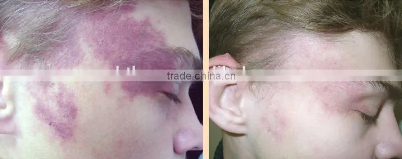 Best Quality Made In China 980nm Medical Diode Laser Spider Vein Removal Machine