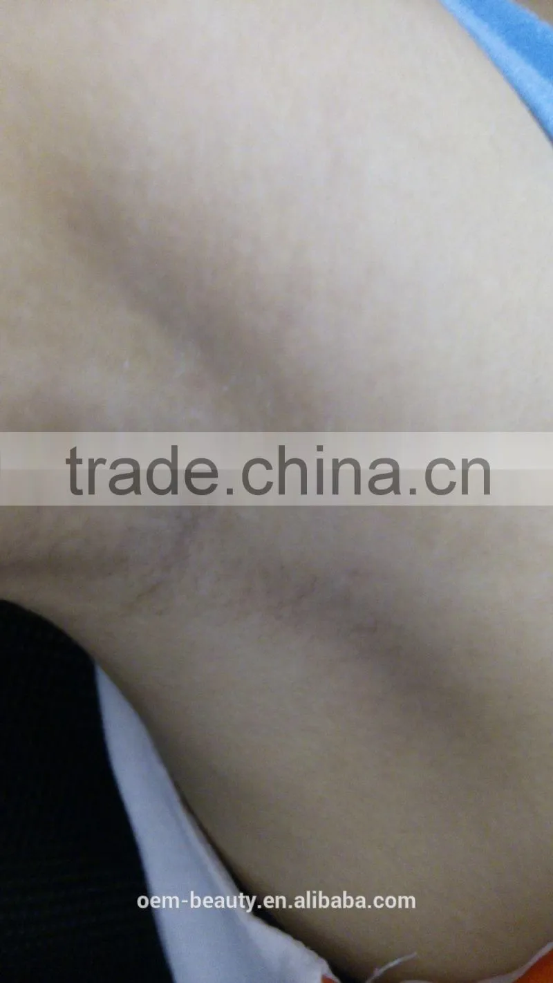 2015 New Arrival 808nm Diode Laser hair removal equipment DL-A1