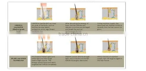 Factory Powerful pain free 808nm diode laser equipment for hair removal