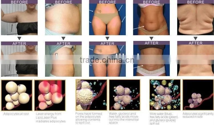 Wholesale Portable Mini I Lipo Laser Machine For Sale Laser Liposuction Machine Lp-01/ce