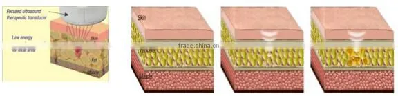 hifu slimming machine price, hifu slimming fat removal, home hifu machine