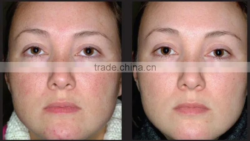 Chinese IPL hair removal from HUAMEI HM-IPL-B1