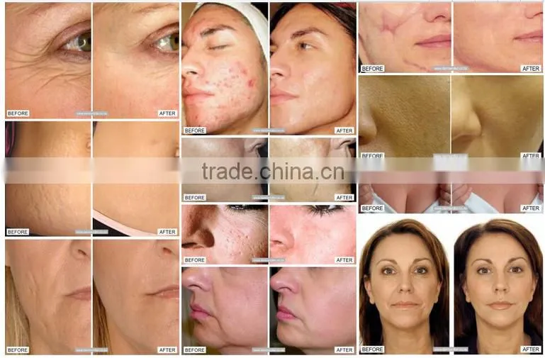 2016 ULTIMA A1-W Electric Derma Pen Stamp Auto Micro Needle Anti-Aging Dr.Pen
