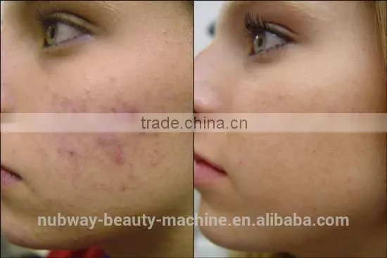 Effectively Best Quality Professional Clinic Use Fractional CO2 Laser Acne Scar Removal
