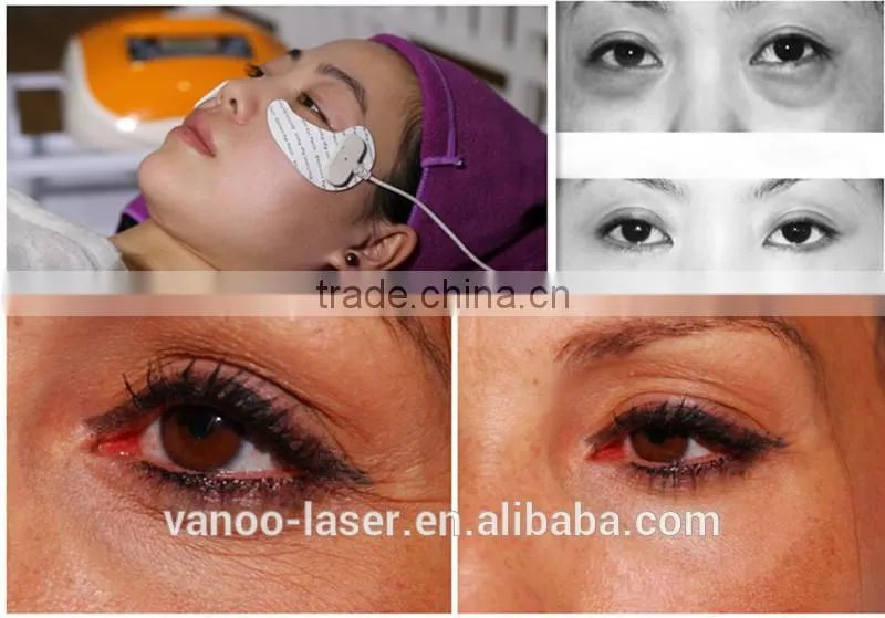 2015 RF Radio Frequency Remove Eye Wrinkle portable device