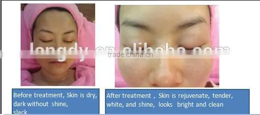 ultrasound facial massage face black spot remover machine with factory direct price